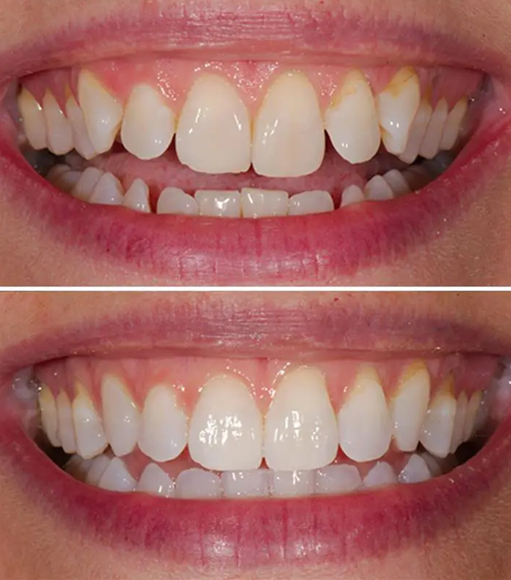 Invisalign